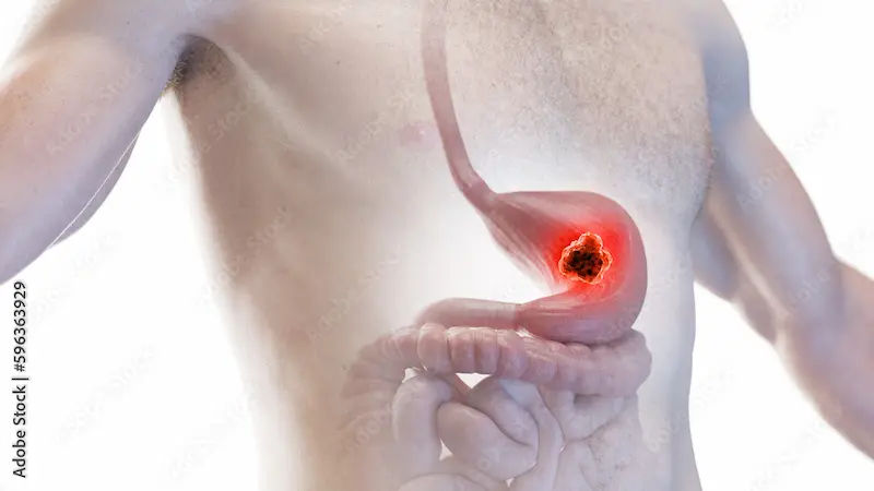 The Ultimate Stomach Ulcer Diet Guide Foods to Eat and Avoid